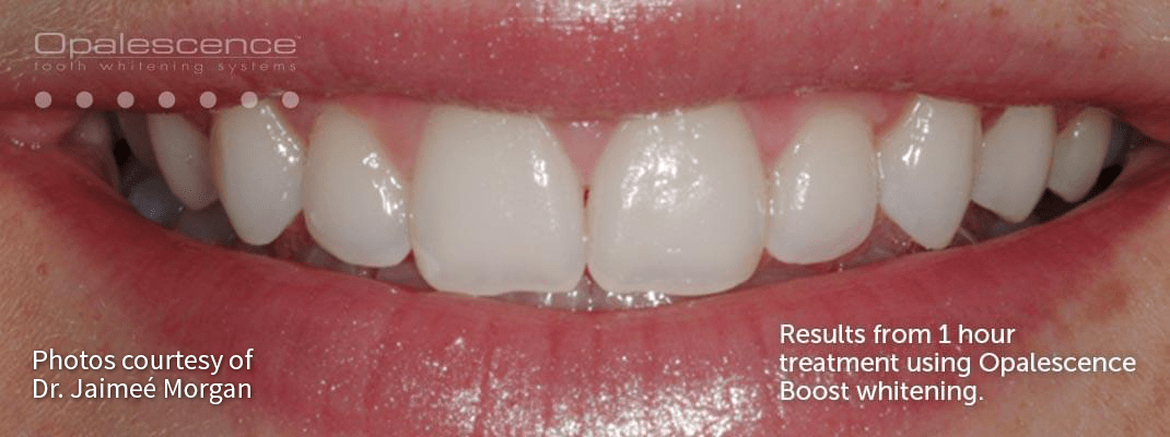 After Opalescence tooth whitening system