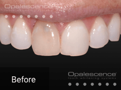 Before using Opalescence Endo